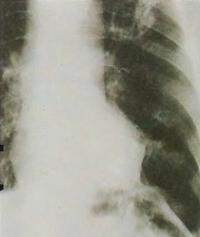 Абсцесс легкого виден на рентгенограмме как гроздеобразная масса в левом легком