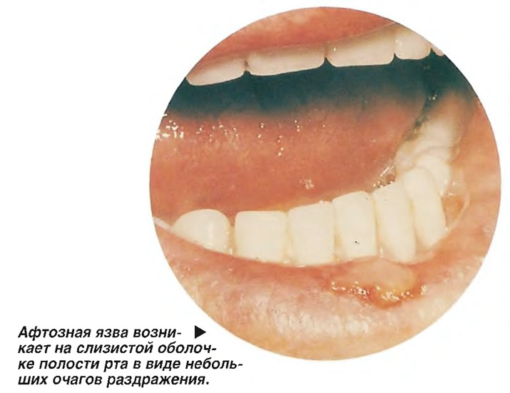 Афтозная язва возникает на слизистой оболочке полости рта