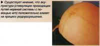 Акупунктура