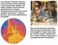 Ангиопластика