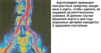 Аортография применяет контрастные средства