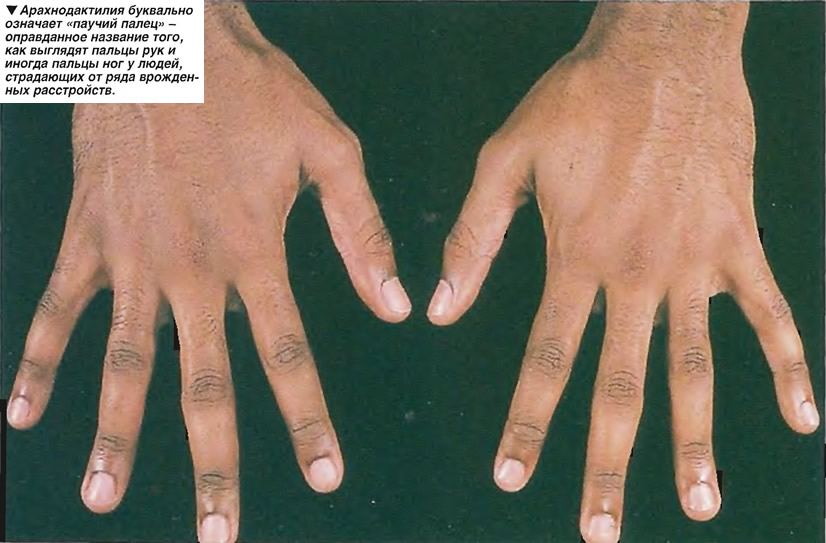 Арахнодактилия буквально означает «паучий палец»