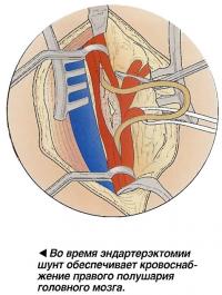 Артерия рассекается на протяжении всего обтурированного участка