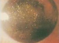 Атропиновые капли используются для расширения зрачка при лечении глазных болезней