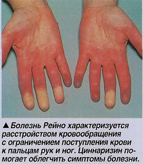 Болезнь Рейно характеризуется расстройством кровообращения к пальцам рук и ног