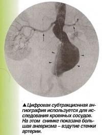 Цифровая субтракционная ангиография используется для исследования кровяных сосудов