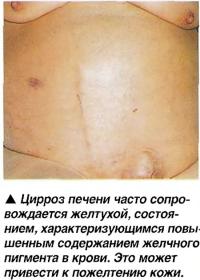 Цирроз печени