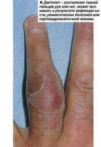 Дактилит - воспаление тканей пальцев рук или ног