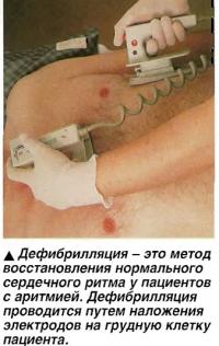 Дефибрилляция - это метод восстановления нормального сердечного ритма у пациентов с аритмией