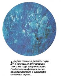 Дерматомикоз диагностируют с помощью флуоресцентного метода визуализации
