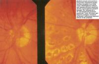 Диабетическая ретинопатия - следствие поражения кровеносных сосудов в сетчатке глаза