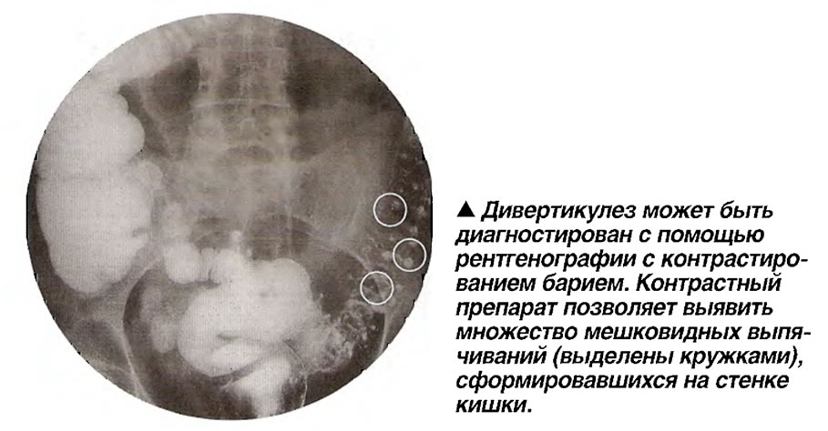 Дивертикулез может быть диагностирован с помощью рентгенографии с контрастированием барием
