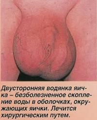 Двусторонняя водянка яичка