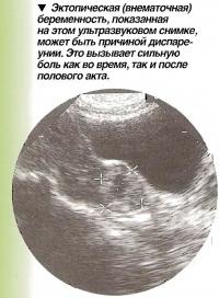 Эктопическая (внематочная) беременность