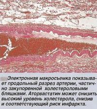 Электронная макросъемка показывает продольный разрез артерии