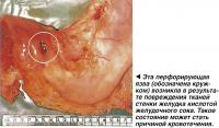 Эта перфорирующая язва возникла в результате повреждения тканей стенки желудка