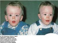 Эти близнецы больны гидроцефалией
