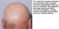Это тяжелый случай алопеции, или облысения
