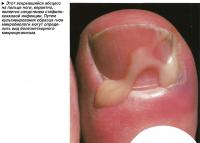 Этот вскрывшийся абсцесс на пальце ноги, вероятно, является следствием стафилококковой инфекции.
