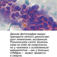 Фотография демонстрирует пневмонию, вызванную Pneumocystis carinii
