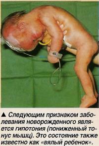 Гипотония
