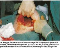 Хирург бережно растягивает отверстие в передней брюшной стенке