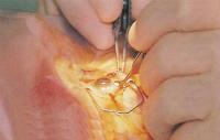Хирург пинцетом держит интраокулярную линзу (искусственный хрусталик)