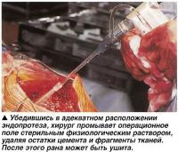 Хирург промывает операционное поле стерильным физиологическим раствором