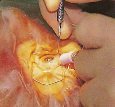Хирург разделяет ядро хрусталика