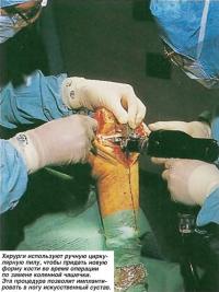 Хирурги используют ручную циркулярную пилу