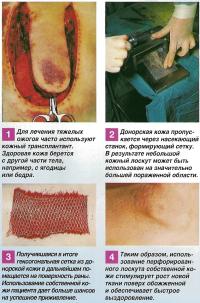 Хирургическое лечение ожоговых ран