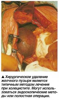 Хирургическое удаление желчного пузыря является типичным методом лечения при холецистите