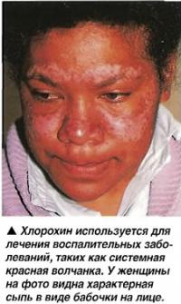 Хлорохин