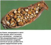 Холецистит