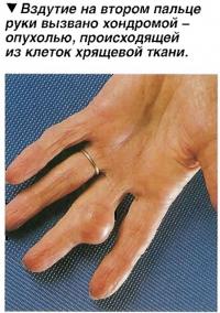 Хондромой
