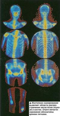 Изотопное сканирование выявляет области распространения метастазов опухоли в костях