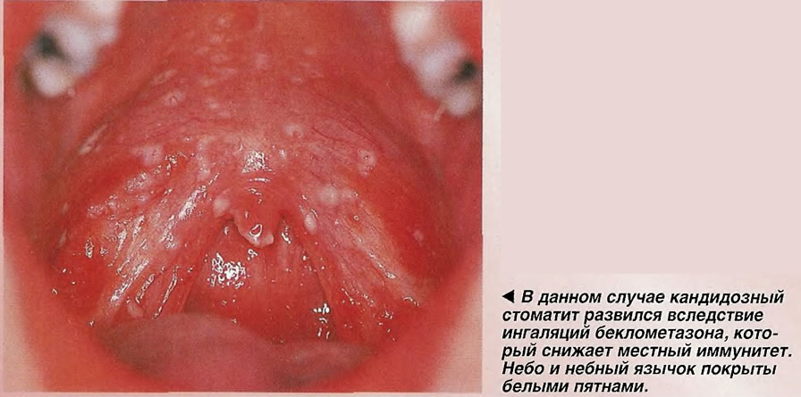 Кандидозный стоматит развился вследствие ингаляций беклометазона