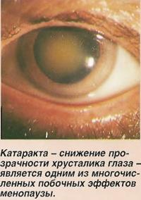 Катаракта - снижение прозрачности хрусталика глаза