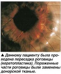 Кератопластика