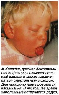 Коклюш, детская бактериальная инфекция