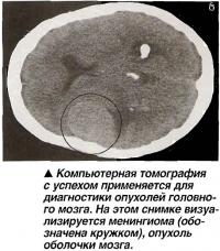 Компьютерная томография с успехом применяется для диагностики опухолей головного мозга.