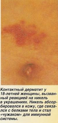 Контактный дерматит, вызванный реакцией на никель в украшениях