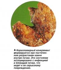 Коралловидный конкремент формируется при постепенном разрастании камня внутри почки