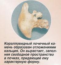 Коралловидный почечный камень образован отложениями кальция