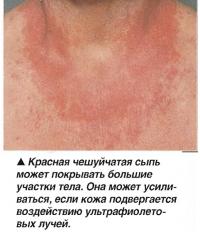Красная чешуйчатая сыпь может покрывать большие участки тела