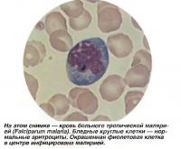 Кровь больного тропической малярией (Falciparum malaria)