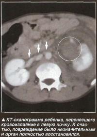 КТ-сканограмма ребенка, перенесшего кровоизлияние в левую почку