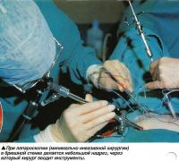 Лапароскопия