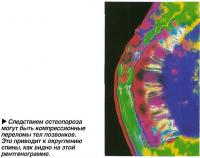 ледствием остеопороза могут быть компрессионные переломы тел позвонков