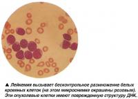 Лейкемия вызывает бесконтрольное размножение белых кровяных клеток